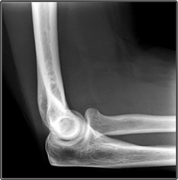 Clinical Anatomy | Radiology | Lateral Elbow