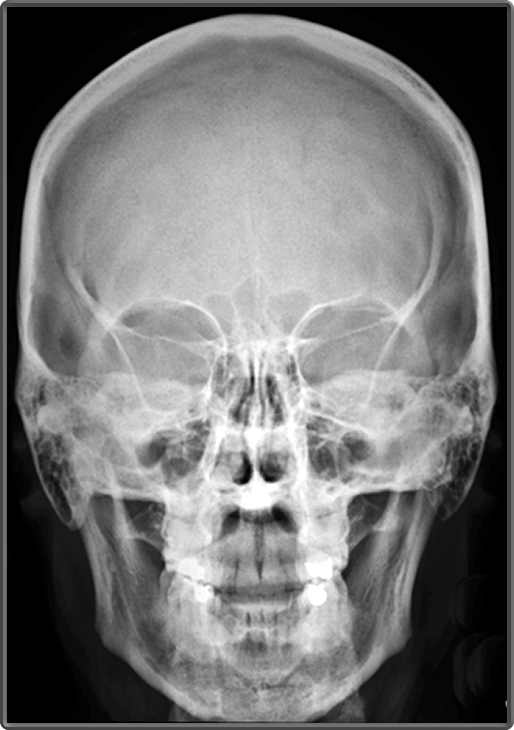 Clinical Anatomy | Radiology | Skull Bones