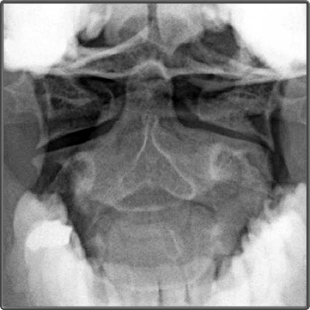 Clinical Anatomy | Radiology | Odontoid Neck