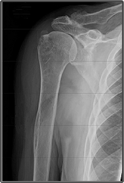 Clinical Anatomy | Radiology | Humerus at Shoulder